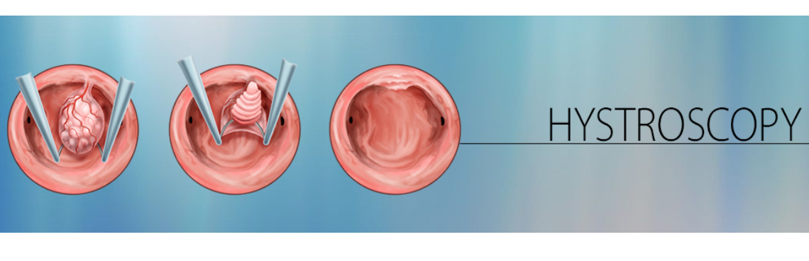 Hystroscopy